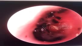 Doctor removes tick stuck to man's eardrum