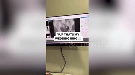 X-ray shows woman's wedding ring after she accidentally swallowed it with vitamins