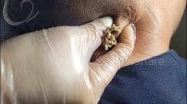Dermatologist Removes Giant 10-Year-Old Pimple From Man's Neck