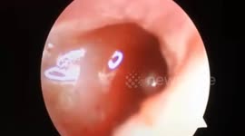 Doctor removes long poisonous worm from man's ear
