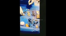 Surgeons remove 56 metal items from teenager's STOMACH