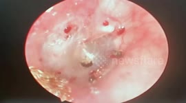 Doctor uses light to attract a poisonous ant crawling into man's ear