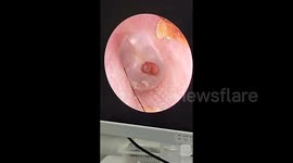 Woman finds cockroach living in her ear after complaining about strange buzzing noise