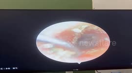 Doctors removed hundreds of grains of sand stuck in a woman's ear after she went swimming at the beach