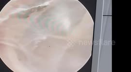 Doctor removes large spider that weaving web in patient's ear