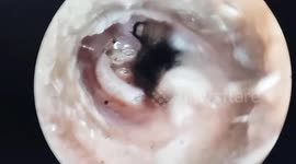 Doctor removes fly and dozens of parasitic fly larvae from man's ear canal