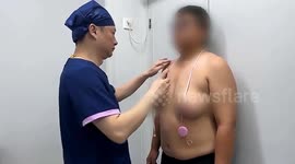 Man, 30, with breast tissue equivalent to women's D cup undergoes surgery in China