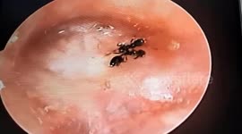 Two large poisonous ants attacked the woman's eardrum
