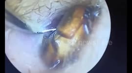 Doctors remove giant beetle from man's ear canal