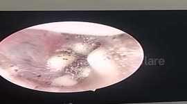 Doctors remove hundreds of mushrooms growing in a woman's ear