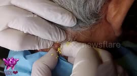 Squeezing a giant cyst with a laser is as unpleasant as you would expect