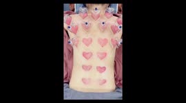 Heart-shaped cupping marks spark reactions in China