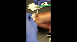 Doctor removes a metal pin after surgery for a fall injury