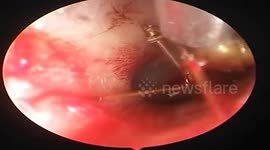 Large venomous ANT removed from patient's ear in Vietnam