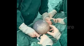 China: Baby born fully encased in amniotic sac in rare 1-in-80,000 birth