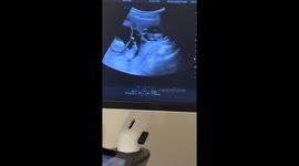 Mom Learns She's Having Quadruplets