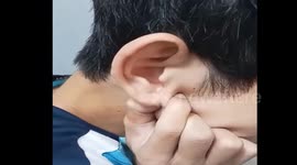 Huge cockroach pulled out of patient's ear in Vietnam