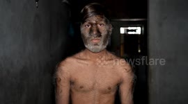 Indian teen with rare 'werewolf syndrome' earns world record for hairiest face on Earth