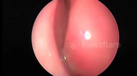 Doctors remove three large leeches living in man's nasal passage