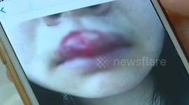 Woman's dog bites her on the lip