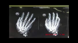Doctor attaches severed hand onto man's leg to keep it alive