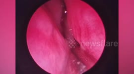 Doctors remove leech from nose of girl, 3, suffering constant bleeding