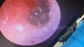 The Doctor removes giant tick that stuck to man's eardrum for a month