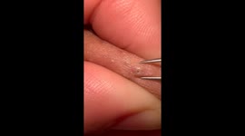 Ingrown hair gets skillfully removed with tweezers in this strangely soothing video