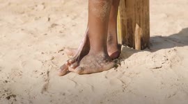 Boy had to walk barefoot for 13 years due to childhood injury - can now wear shoes