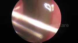 Doctor removes 20-cm-long live leech from inside patient's nose