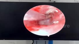 Doctors remove a butterfly stuck in a man's eardrum for five days