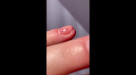 Pimples on nails