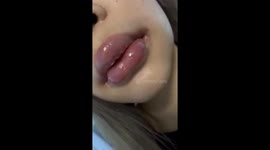 Lip filler allergic reaction leaves model, 27, with horrifying 'trout pout'