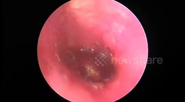 The Doctors remove beetle stuck in man's ear canal