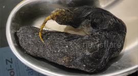 Doctor removed a clump of hair weighing about one kilogram from the stomach of a woman through surgery in Madhepura, Northern India