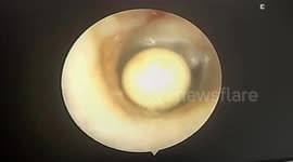 The missing pearl was in the ear canal of a six-year-old boy