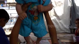 Gazan boy loses leg in Israeli airstrike while seeking food from aid site backed by U.S., Israel