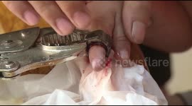 Firefighters rescue a three-year-old boy stuck his finger in screw cap