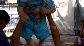 Gazan boy loses leg in Israeli airstrike while seeking food from aid site backed by U.S., Israel