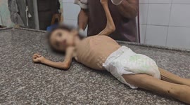 4-year-old Palestinian child dies from malnutrition amid Israeli blockade on Gaza