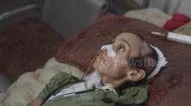 Israeli strikes, blockade drive widespread malnutrition in Gaza