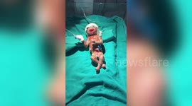 ‘Alien-like’ baby born with rare skin disorder, missing facial features, stuns doctors