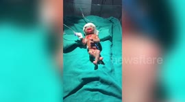 India: Exclusive Story: ‘Alien-like’ baby born with rare skin disorder, missing facial features, stuns doctors