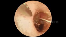 Doctor pulls LIVE cockroach from patient's ear in skin-crawling footage
