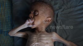 Emaciated Palestinian child embodies Gaza’s starvation crisis despite Israeli denial