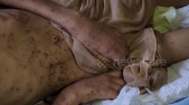 Gaza boy paralyzed in airstrike faces worsening health amid medical shortages