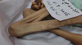 Starvation kills young Palestinian man as Israeli blockade intensifies in Gaza