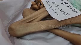 Starvation kills young Palestinian man as Israeli blockade intensifies in Gaza
