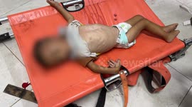 Palestinian baby dies of severe malnutrition amid Israeli-imposed famine in southern Gaza