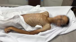 Palestinian teen dies of malnutrition in Gaza amid ongoing blockade